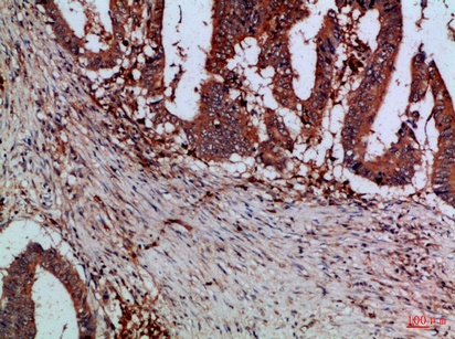 Fig.2. Immunohistochemical analysis of paraffin-embedded Human-colon-cancer, antibody was diluted at 1:100.