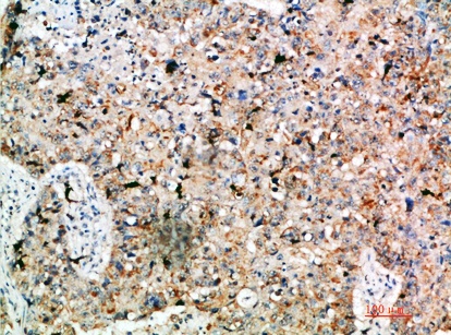 Fig.3. Immunohistochemical analysis of paraffin-embedded human-lung-cancer, antibody was diluted at 1:200.