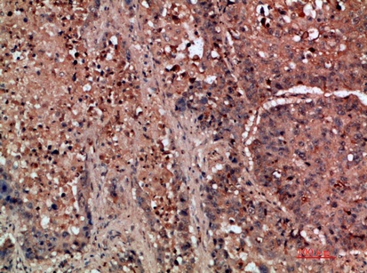 Fig.1. Immunohistochemical analysis of paraffin-embedded human-lung-cancer, antibody was diluted at 1:200.