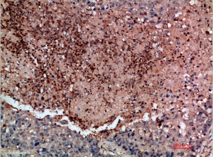 Fig.2. Immunohistochemical analysis of paraffin-embedded human-lung-cancer, antibody was diluted at 1:200.