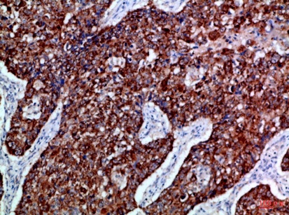 Fig.3. Immunohistochemical analysis of paraffin-embedded Human-lung-cancer, antibody was diluted at 1:100.