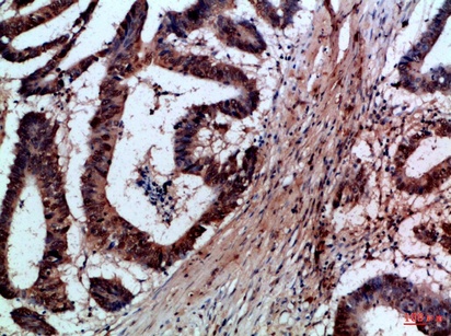 Fig.1. Immunohistochemical analysis of paraffin-embedded Human-colon-cancer, antibody was diluted at 1:100.