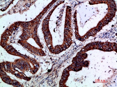 Fig.4. Immunohistochemical analysis of paraffin-embedded human-colon-cancer, antibody was diluted at 1:200.