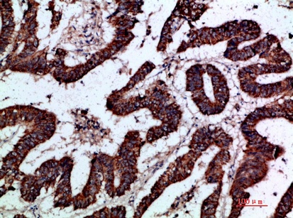 Fig.5. Immunohistochemical analysis of paraffin-embedded human-colon-cancer, antibody was diluted at 1:200.