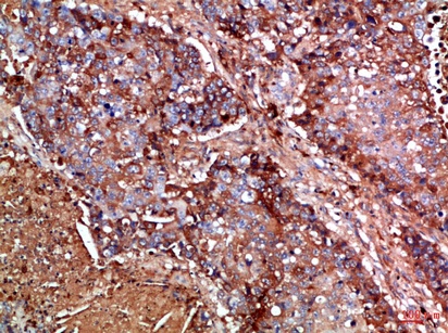 Fig.3. Immunohistochemical analysis of paraffin-embedded Human-lung-cancer, antibody was diluted at 1:100.