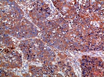 Fig.4. Immunohistochemical analysis of paraffin-embedded Human-lung-cancer, antibody was diluted at 1:100.