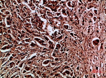 Fig.1. Immunohistochemical analysis of paraffin-embedded human-breast-cancer, antibody was diluted at 1:200.