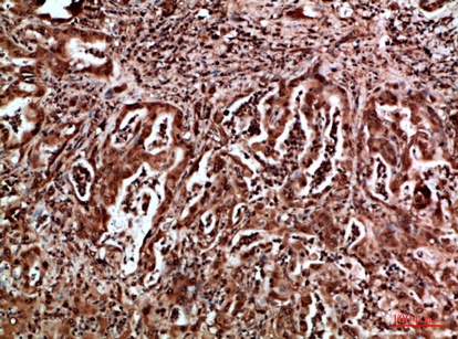 Fig.3. Immunohistochemical analysis of paraffin-embedded human-liver-cancer, antibody was diluted at 1:200.