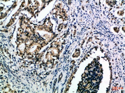 Fig.1. Immunohistochemical analysis of paraffin-embedded Human-breast-cancer, antibody was diluted at 1:100.