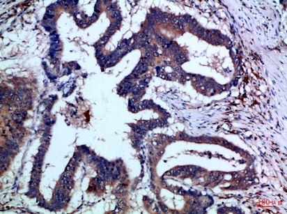 Fig.1. Immunohistochemical analysis of paraffin-embedded Human-colon-cancer, antibody was diluted at 1:100.