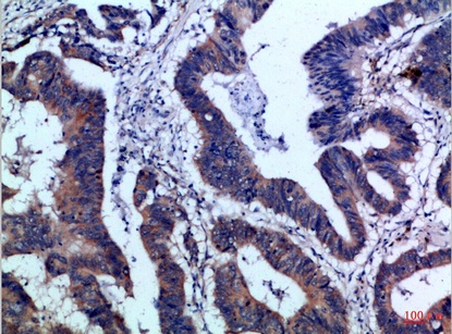 Fig.2. Immunohistochemical analysis of paraffin-embedded Human-colon-cancer, antibody was diluted at 1:100.