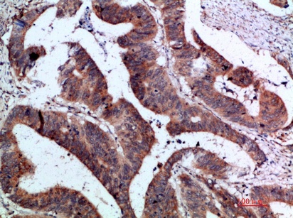 Fig.3. Immunohistochemical analysis of paraffin-embedded human-colon-cancer, antibody was diluted at 1:200.
