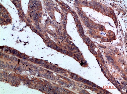 Fig.4. Immunohistochemical analysis of paraffin-embedded human-colon-cancer, antibody was diluted at 1:200.