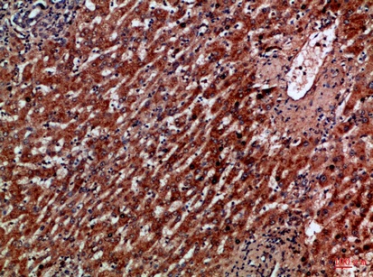 Fig.1. Immunohistochemical analysis of paraffin-embedded Human-liver-cancer, antibody was diluted at 1:100.