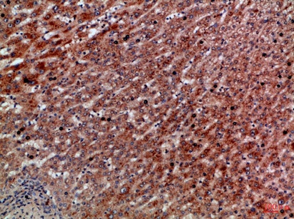 Fig.2. Immunohistochemical analysis of paraffin-embedded Human-liver-cancer, antibody was diluted at 1:100.