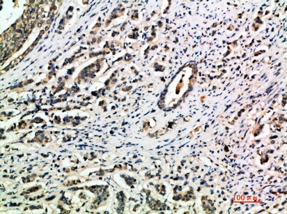 Fig.1. Immunohistochemical analysis of paraffin-embedded human-breast-cancer, antibody was diluted at 1:200.