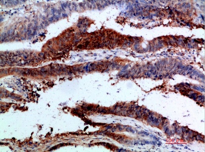 Fig.3. Immunohistochemical analysis of paraffin-embedded human-colon-cancer, antibody was diluted at 1:200.