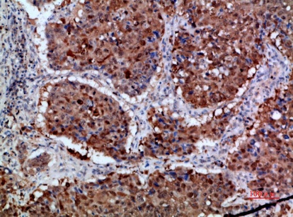 Fig.4. Immunohistochemical analysis of paraffin-embedded human-lung-cancer, antibody was diluted at 1:200.
