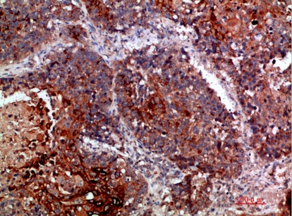 Fig.1. Immunohistochemical analysis of paraffin-embedded human-lung-cancer, antibody was diluted at 1:200.