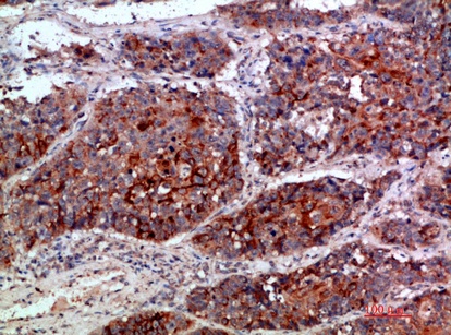 Fig.2. Immunohistochemical analysis of paraffin-embedded human-lung-cancer, antibody was diluted at 1:200.