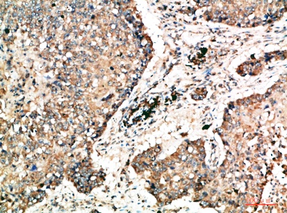 Fig.1. Immunohistochemical analysis of paraffin-embedded human-lung-cancer, antibody was diluted at 1:200.