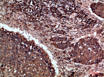 Fig.2. Immunohistochemical analysis of paraffin-embedded human-lung-cancer, antibody was diluted at 1:200.
