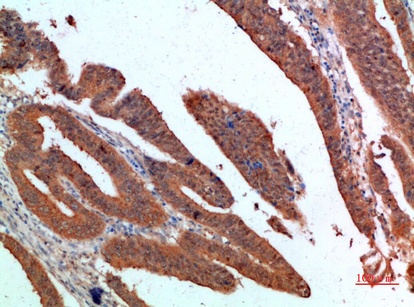 Fig.1. Immunohistochemical analysis of paraffin-embedded human-colon-cancer, antibody was diluted at 1:200.
