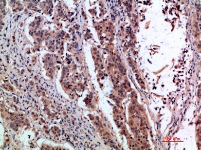 Fig.1. Immunohistochemical analysis of paraffin-embedded human-breast-cancer, antibody was diluted at 1:200.