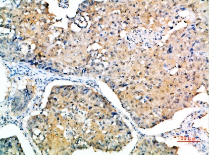Fig.1. Immunohistochemical analysis of paraffin-embedded human-lung-cancer, antibody was diluted at 1:200.
