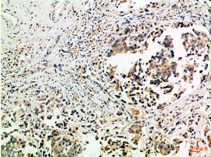 Fig.1. Immunohistochemical analysis of paraffin-embedded Human-breast-cancer, antibody was diluted at 1:100.