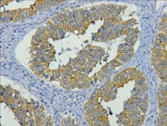 Fig. IHC-P staining of human colon cancer tissue, diluted at 1:200.