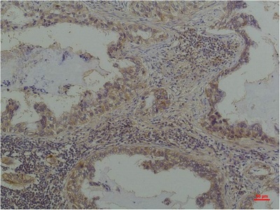 Fig.2. Immunohistochemical analysis of paraffin-embedded Human Lung Caricnoma using Phosphoserine Mouse mAb diluted at 1:200.