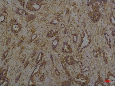 Fig.3. Immunohistochemical analysis of paraffin-embedded Human Breast Caricnoma using Phosphoserine Mouse mAb diluted at 1:200.