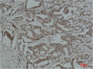 Fig.2. Immunohistochemical analysis of paraffin-embedded Human Breast Carcinoma using Acetyl Lysine Monoclonal Antibody.