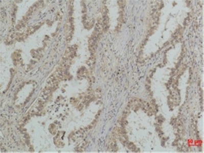 Fig. Immunohistochemical analysis of paraffin-embedded Human Lung Carcinoma using P53 (Mono Methyl Lys370) Mouse mAb diluted at 1:500.