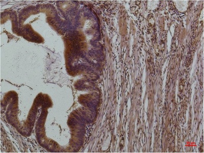 Fig.2. Immunohistochemical analysis of paraffin-embedded Human Colon Carcinoma using STAT3Mouse mAb diluted at 1:200.