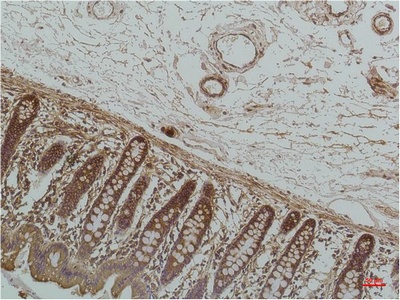 Fig.2. Immunohistochemical analysis of paraffin-embedded Human Colon Caricnoma using GRP78/BipMouse mAb diluted at 1:200.