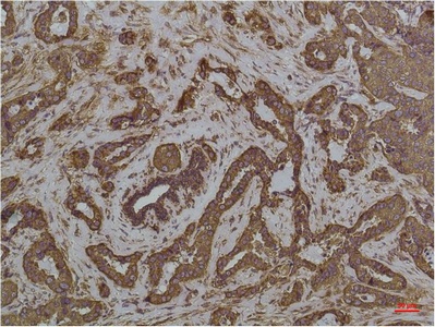 Fig.3. Immunohistochemical analysis of paraffin-embedded Human Breast Caricnoma using GRP78/BipMouse mAb diluted at 1:200.