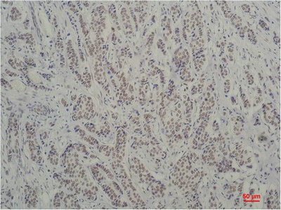 Fig.1. Immunohistochemical analysis of paraffin-embedded Human Breast Carcinoma using TBP/TATA Binding Protein (mAb diluted at 1:200.
