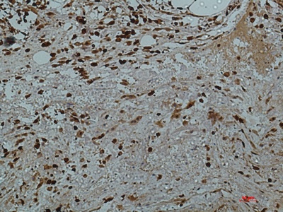 Fig.3. Immunohistochemical analysis of paraffin-embedded human-colon2 using antibody diluted at 1:50.