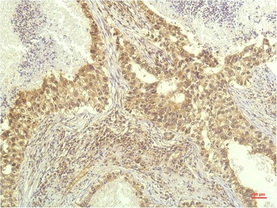 Fig.1. Immunohistochemical analysis of paraffin-embedded Human Lung Carcinoma Tissue using P70 S6 Kinase Mouse mAb diluted at 1:200.