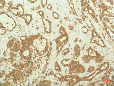 Fig.2. Immunohistochemical analysis of paraffin-embedded Human Breast Carcinoma Tissue using P70 S6 Kinase Mouse mAb diluted at 1:200.