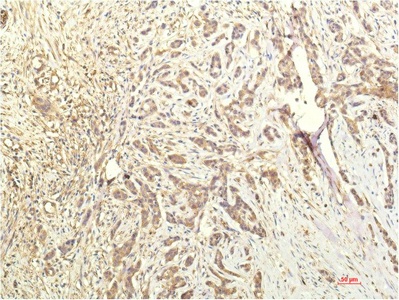Fig.2. Immunohistochemical analysis of paraffin-embedded Human Breast CarcinomaTissue using STAT1 Mouse mAb diluted at 1:200.