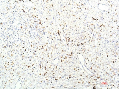Fig.2. Immunohistochemical analysis of paraffin-embedded Human Breast Carcinoma Tissue using JAK1 Mouse mAb diluted at 1:200.