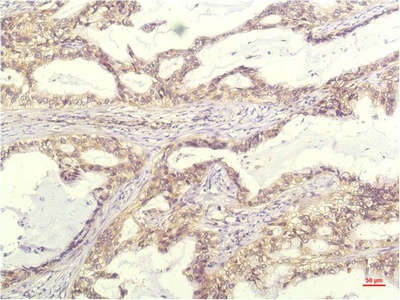 Fig.1. Immunohistochemical analysis of paraffin-embedded Human Lung Carrcinoma Tissue using IL-8 Mouse mAb diluted at 1:200.