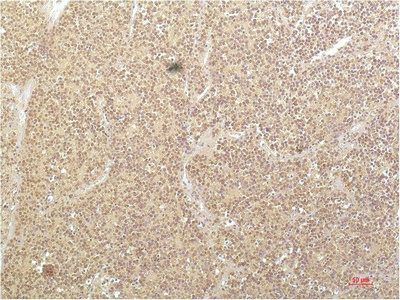 Fig.2. Immunohistochemical analysis of paraffin-embedded Human Kidney Carcinoma Tissue using SGK1 Mouse mAb diluted at 1:200.