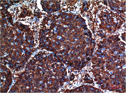 Fig.1. Immunohistochemical analysis of paraffin-embedded Human Lung Carcinoma Tissue using Akt Mouse mAb diluted at 1:200.