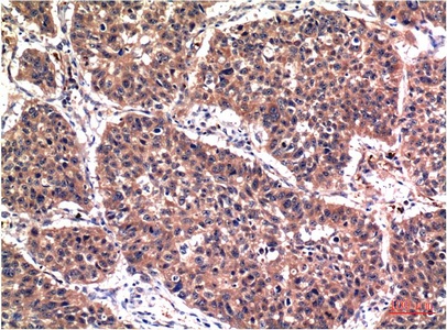 Fig.1. Immunohistochemical analysis of paraffin-embedded Human Lung Carcinoma Tissue using Phospho-Akt Ser473 Mouse mAb diluted at 1:200.