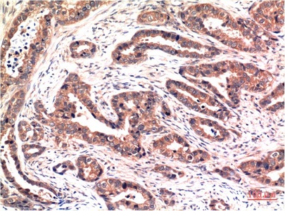 Fig.2. Immunohistochemical analysis of paraffin-embedded Human Breast Carcinoma Tissue using Phospho-Akt Ser473 Mouse mAb diluted at 1:200.