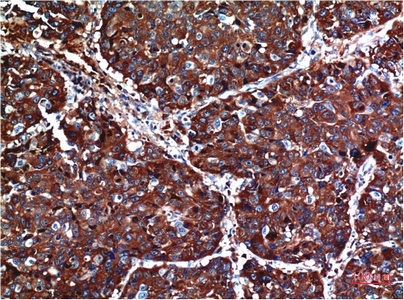 Fig.1. Immunohistochemical analysis of paraffin-embedded Human Lung Carcinoma Tissue using Akt Mouse mAb diluted at 1:200.